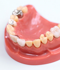 銀歯におけるリスクについて